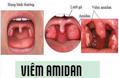 Viêm amidan cấp: nguyên nhân, triệu chứng, cách điều trị và phòng ngừa