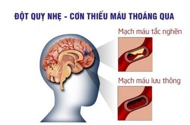 Đột quỵ là gì? Nguyên nhân, dấu hiệu nhận biết và cách phục hồi