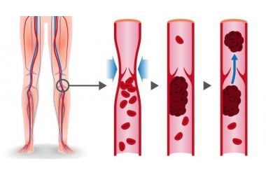 Thuyên tắc huyết khối tĩnh mạch: Nguyên nhân và cách điều trị